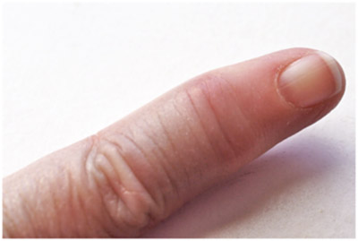 symvoules_gia_pswriasikh_arthritida